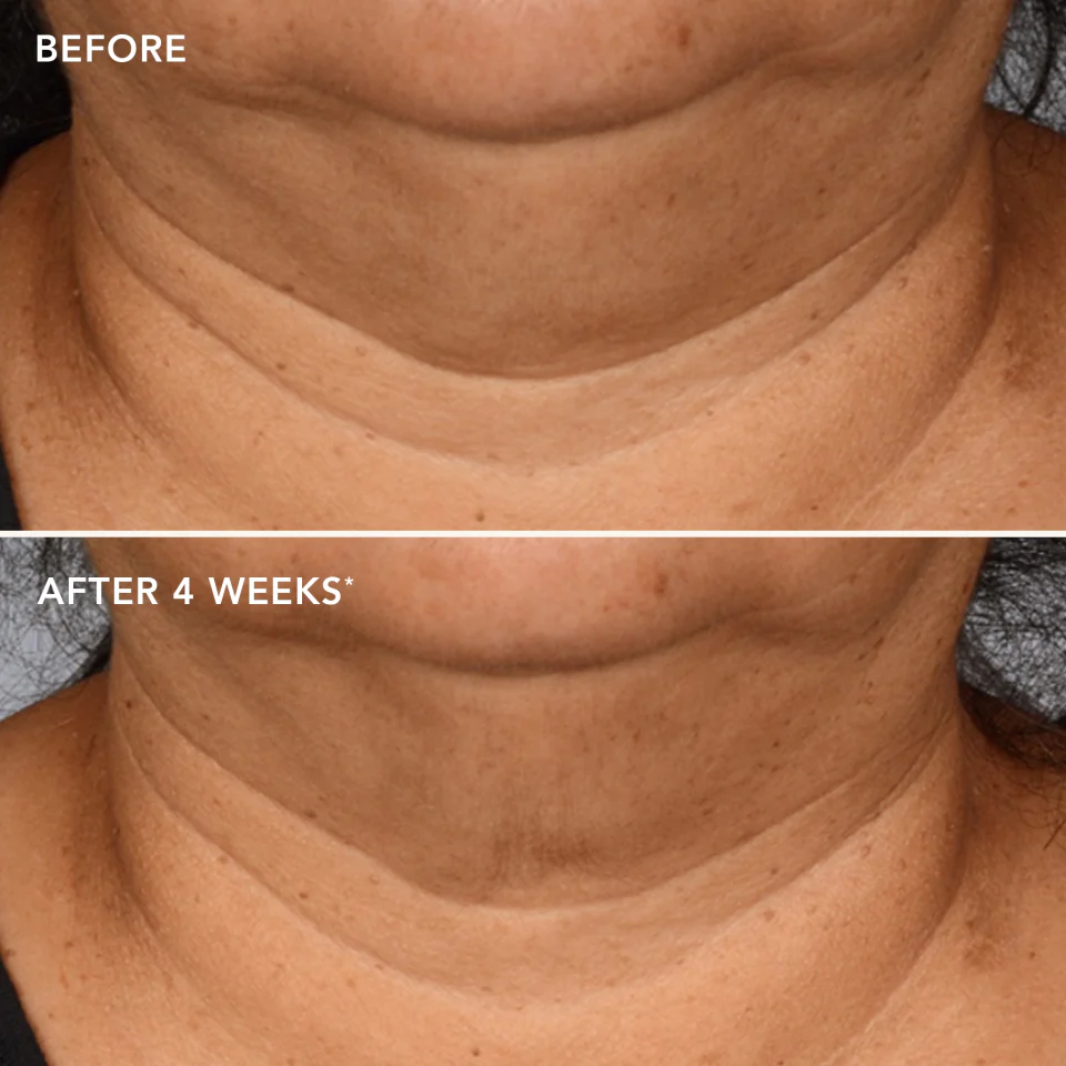 MAX™ neck lift 4 MAX™ neck lift